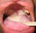 /album/fotogaleria/candidiasis-tongue-palate-jpg/